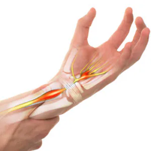 Síndrome do Túnel do Carpo; compressão do nervo mediano pelo ligamento transverso.